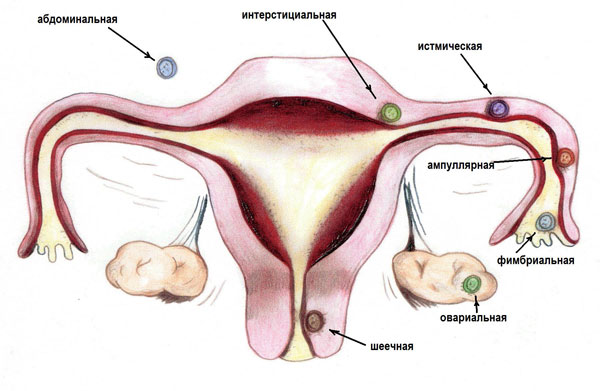 Ciąża pozamaciczna ( ciąża pozamaciczna ) jest niebezpiecznym schorzeniem charakteryzującym się wszczepieniem zapłodnionego jaja poza macicę